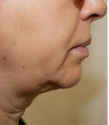 Ultraformer Baby Face 5