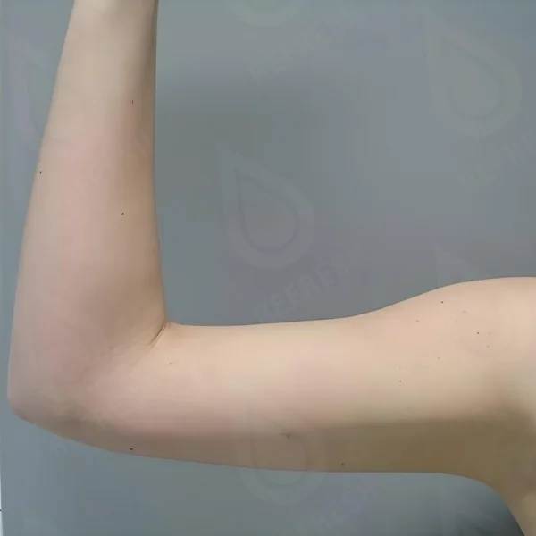 Волновая терапия Shock Wave Storz 3