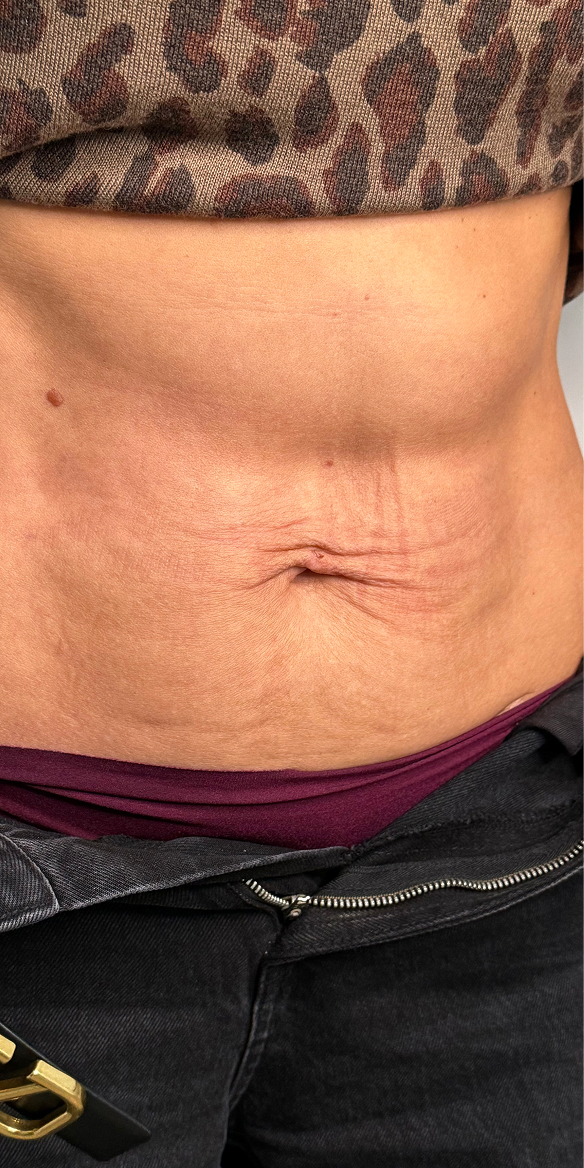 Morpheus-лифтинг 1