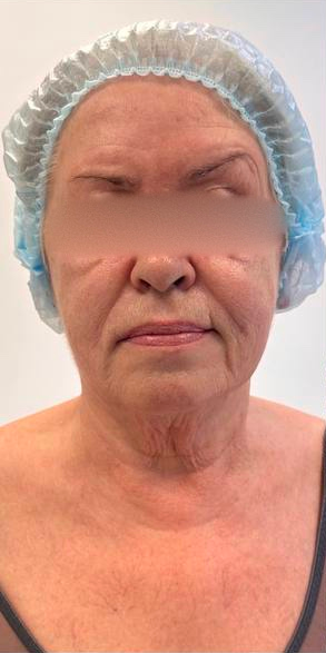 SMAS-лифтинг Ultraformer 1