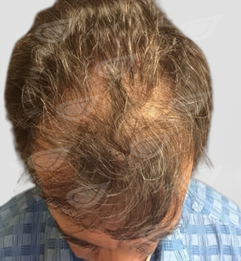 Экзосомы для волос 2