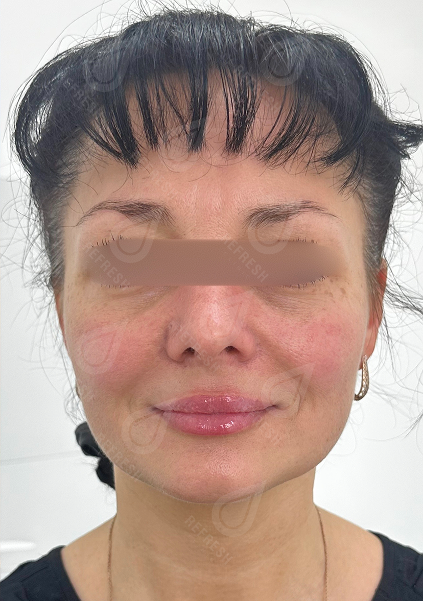 Косметология, инъекции, подтяжка, увеличение губ