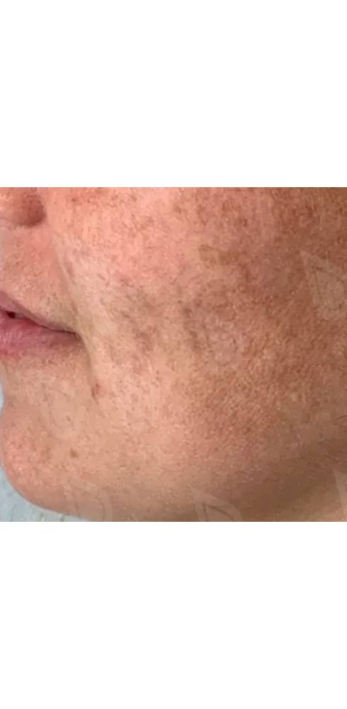 Фототерапия 2