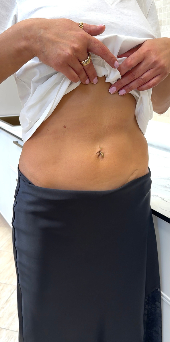 Morpheus-лифтинг 2