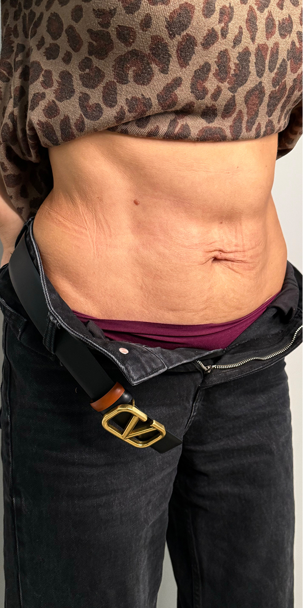 Morpheus-лифтинг 2