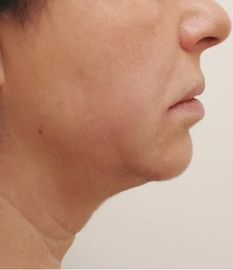 Ultraformer Baby Face 5