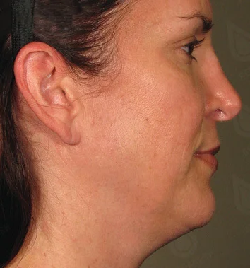 Ultraformer Baby Face 2