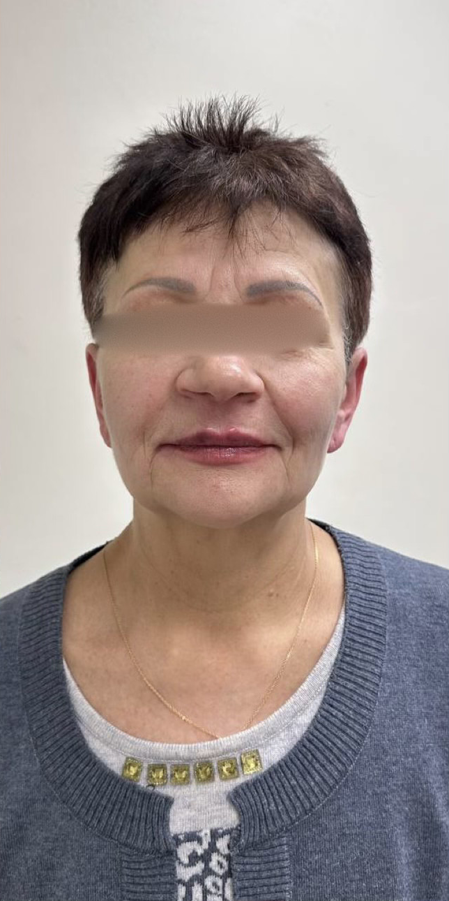 SMAS-лифтинг Ultraformer 2