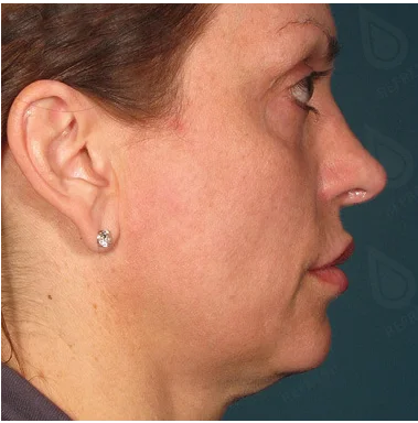 Ultraformer Baby Face 3