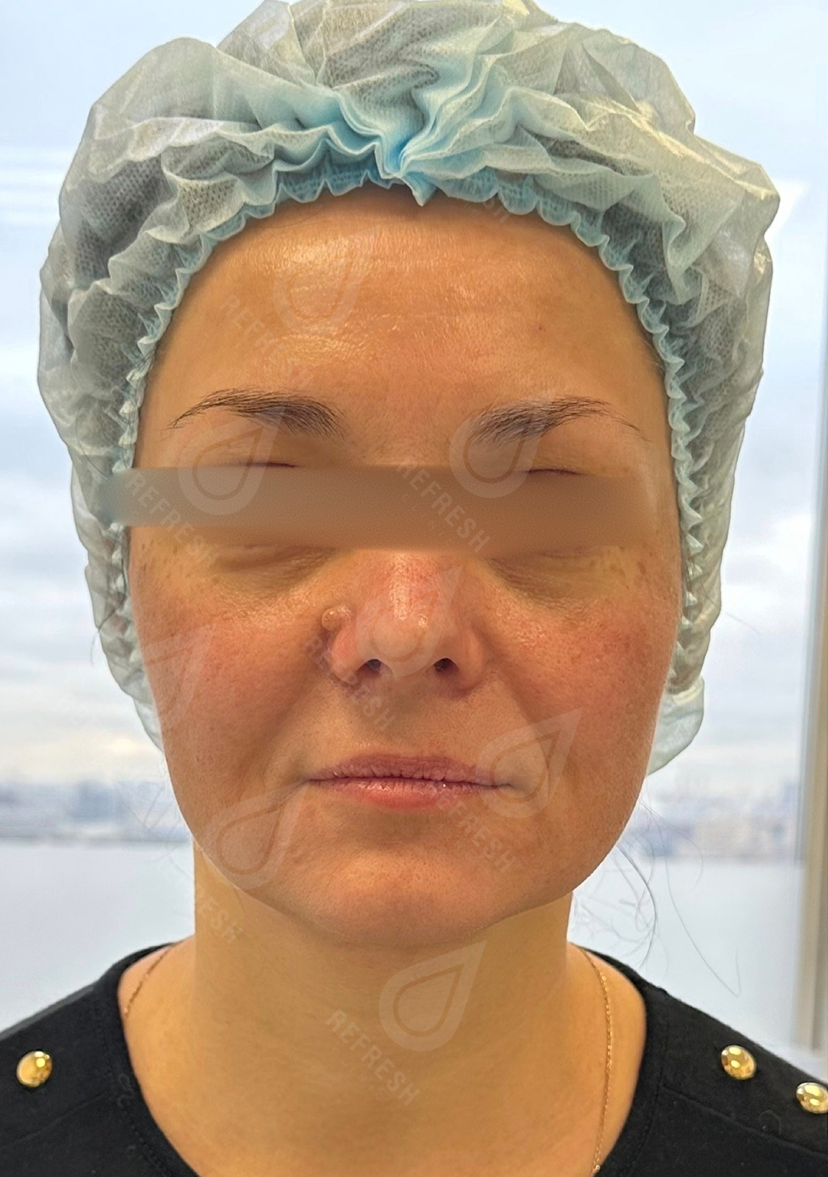 Косметология, инъекции, подтяжка, увеличение губ