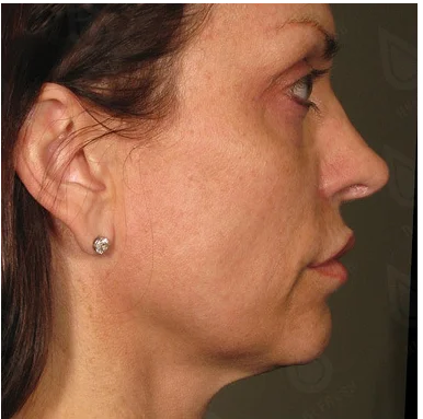 Ultraformer Baby Face 3