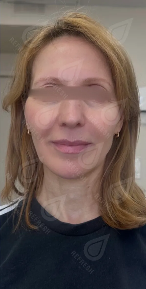 Косметология, инъекции, подтяжка, ботокс