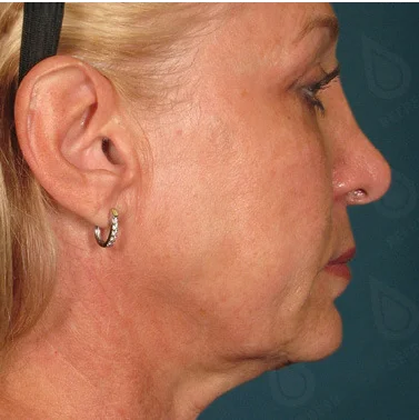 Ultraformer Baby Face 1