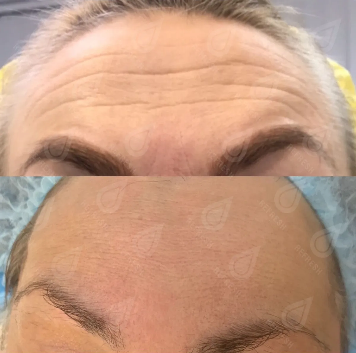 Косметология, инъекции, ботокс зона лба