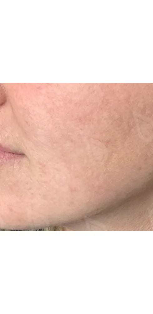 Фототерапия 2