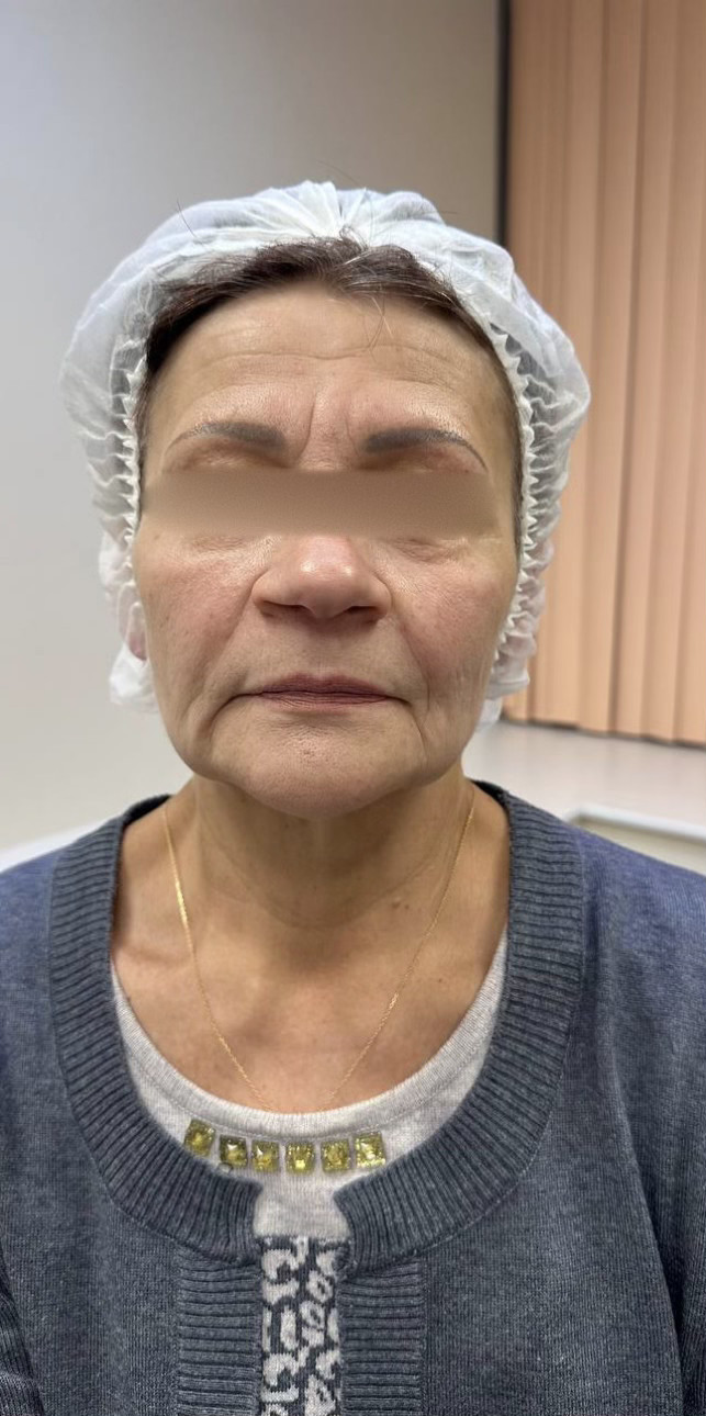 SMAS-лифтинг Ultraformer 2