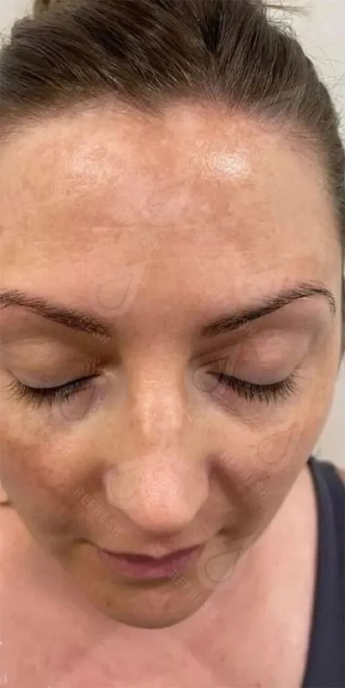 Биоревитализация 1