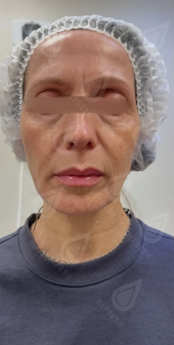 Косметология, инъекции, подтяжка, ботокс