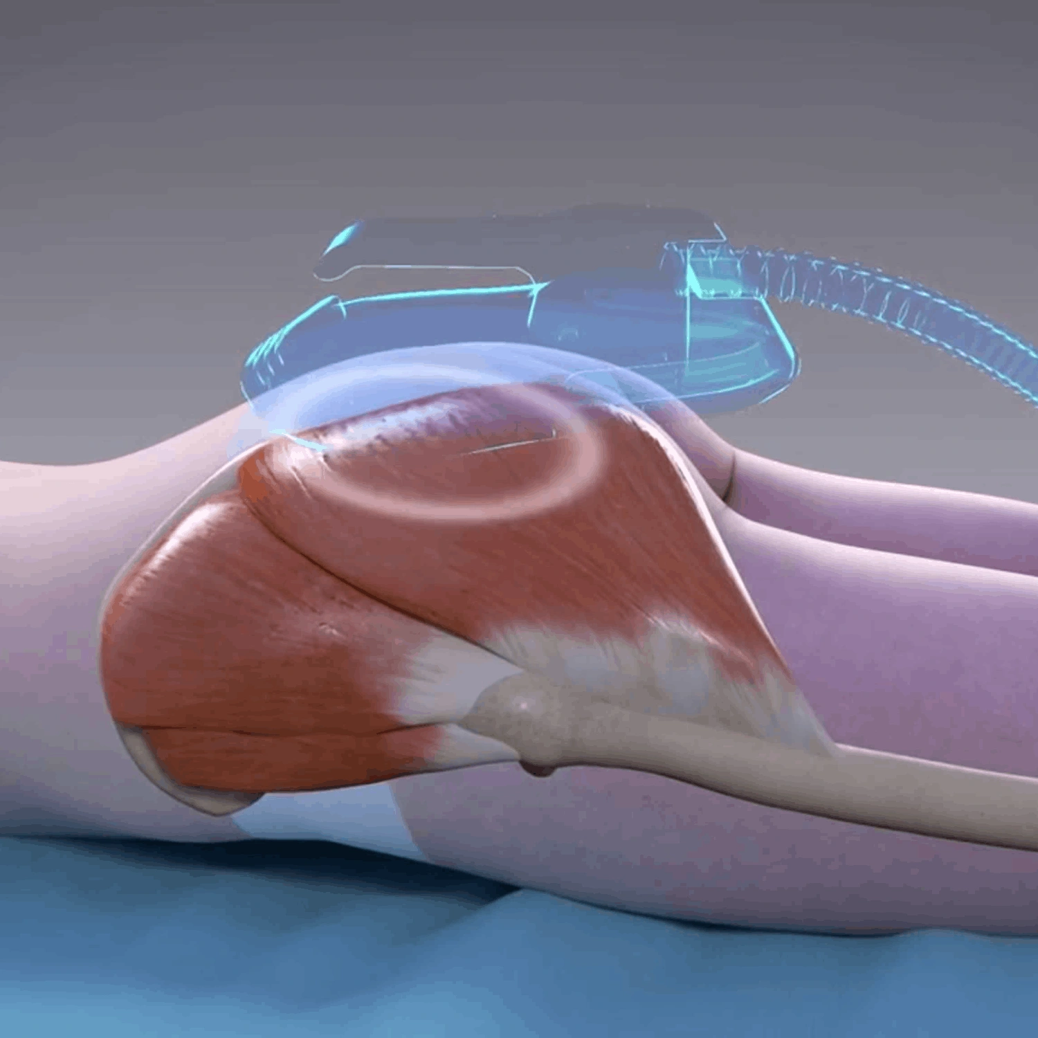 Специальная цена на курсовую программу EMSCULPT Специальная цена на курсовую программу EMSCULPT