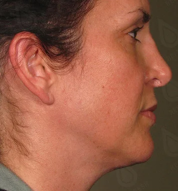 Ultraformer Baby Face 2