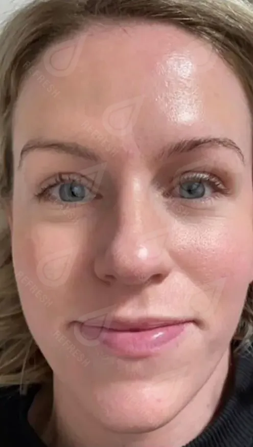 Фототерапия