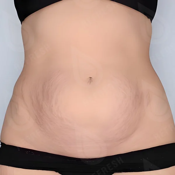 BTL Exilis 2