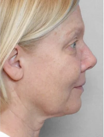 Ultraformer Baby Face 4