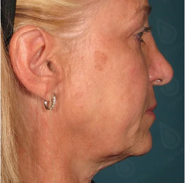 Ultraformer Baby Face 1