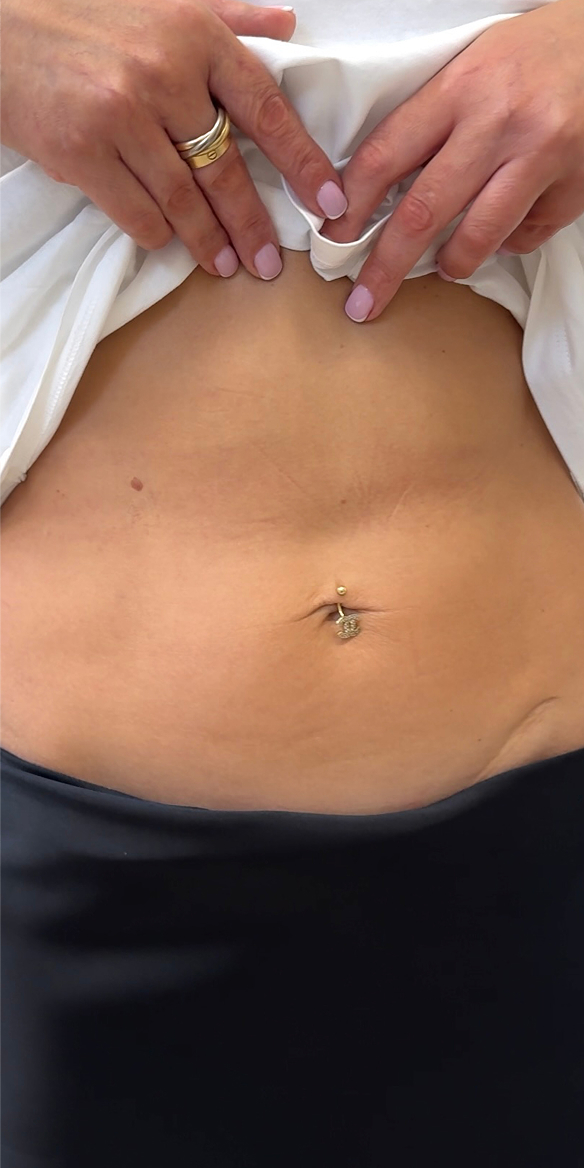 Morpheus-лифтинг 1