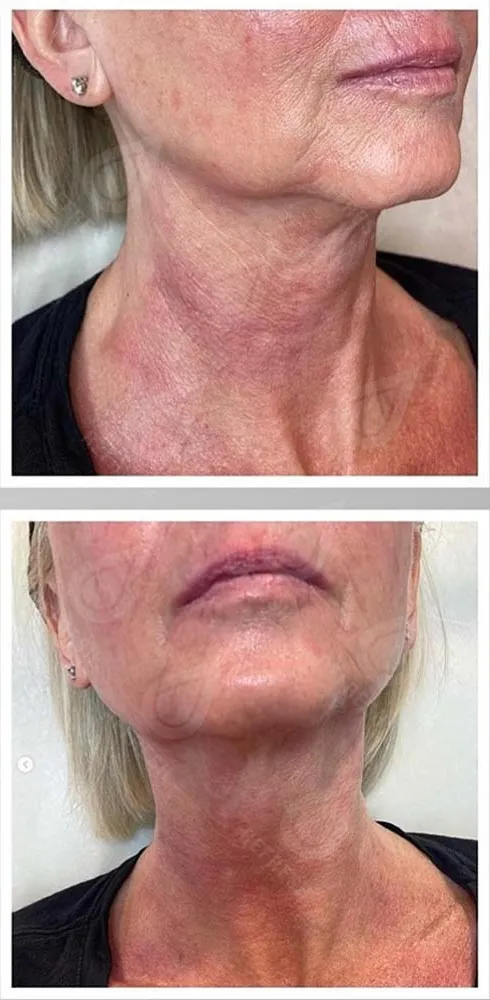 Биоревитализация 3