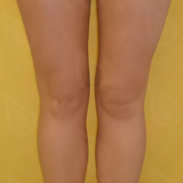 Волновая терапия Shock Wave Storz 2