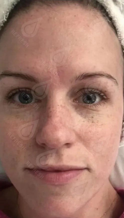 Фототерапия