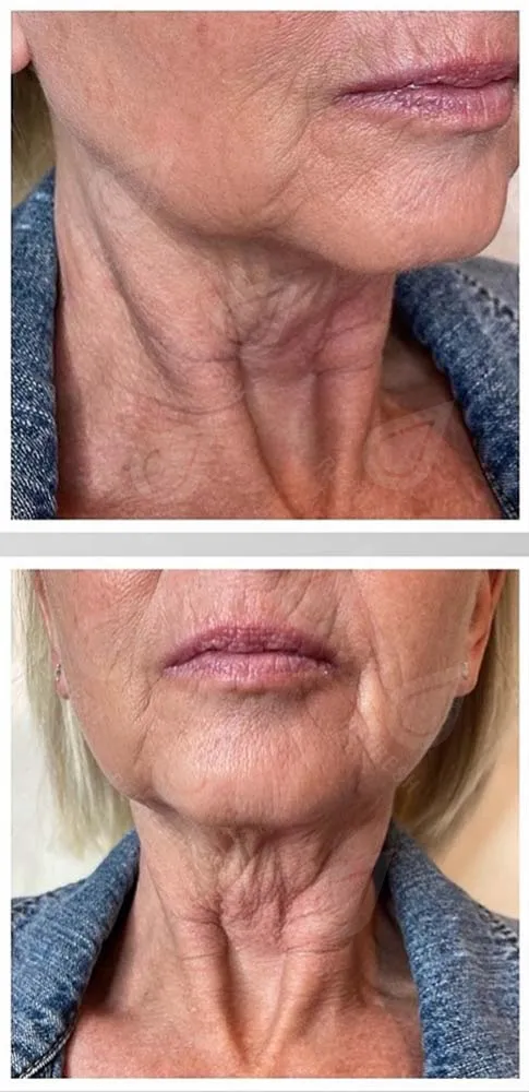 Биоревитализация 3