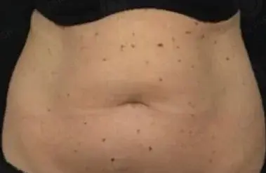 Локальное жиросжигание 1