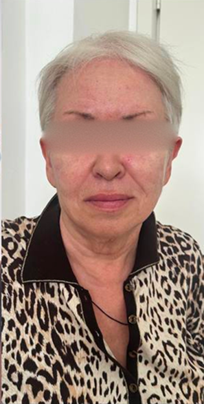 SMAS-лифтинг Ultraformer 1