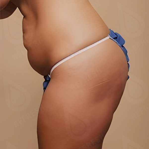 Волновая терапия Shock Wave Storz