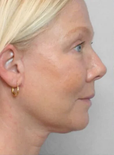 Ultraformer Baby Face 4