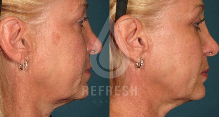 refrshdoctor_ultraformer_results 2.png